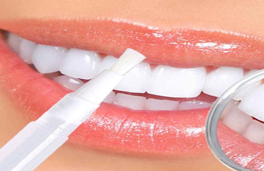 استفاده از سفید‌کننده‌های دندان