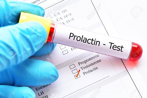 آزمایش پرولاکتین (PRL) چیست؟